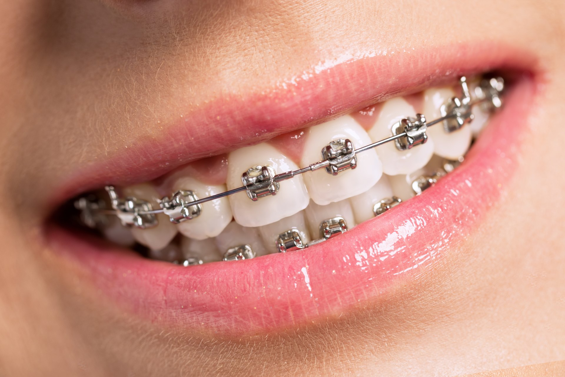 Invisalign or Clear Aligners