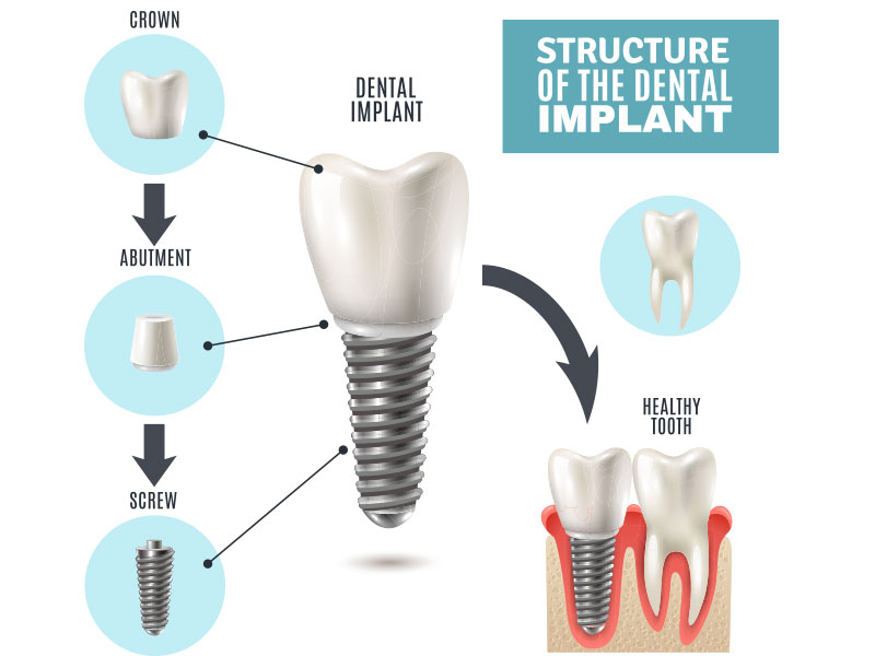 Implants parts