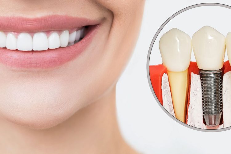 dental implants awareness month