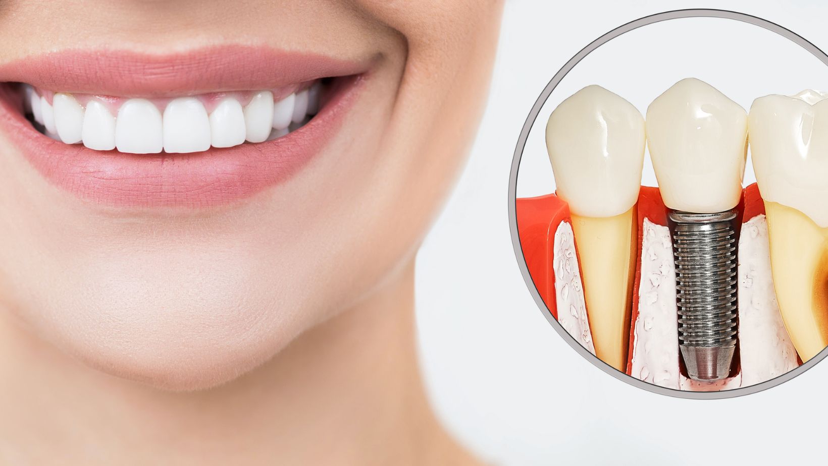dental implants awareness month
